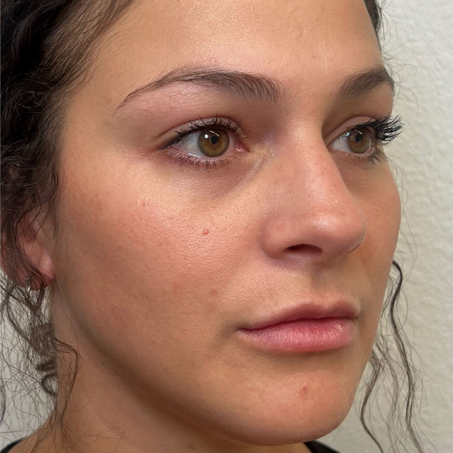 full face filler after